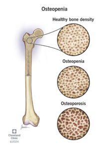 osteoporoza
